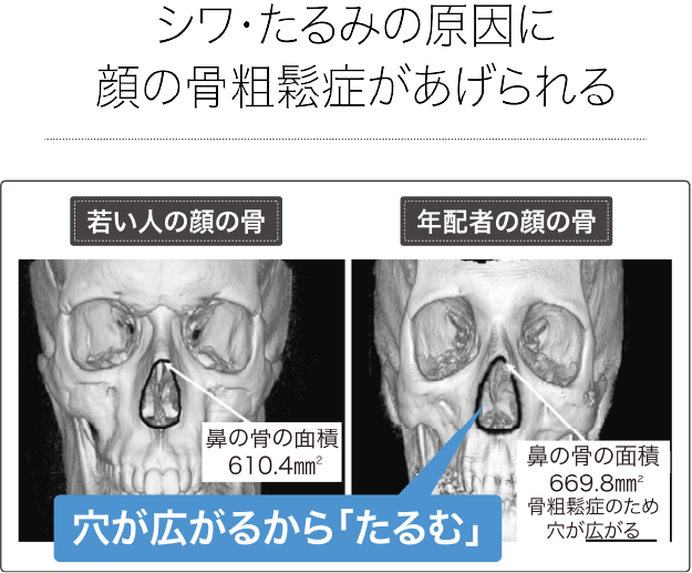 シワ・たるみの原因に顔の骨粗鬆症があげられる